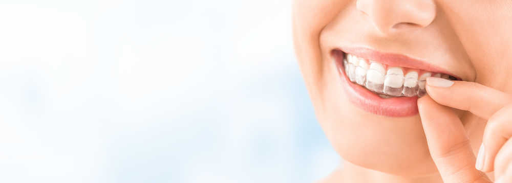 La ortodoncia invisible: ¿es rentable?